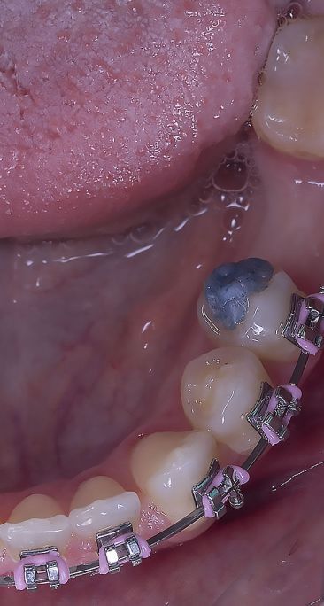 Aparelho dentário